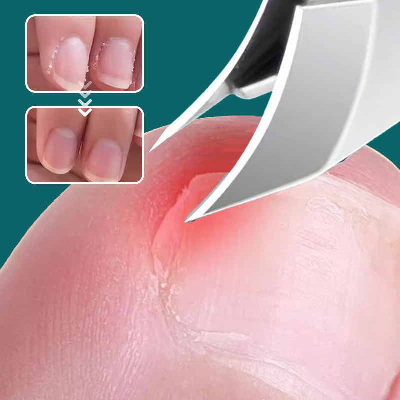 🔥50% RABATT NUR ZEITLIMITIERT🎁 Spritzschutz-Nagelknipser-Set mit 25°-Schrägklinge, 3-teilig | Keine Spritzer mehr!